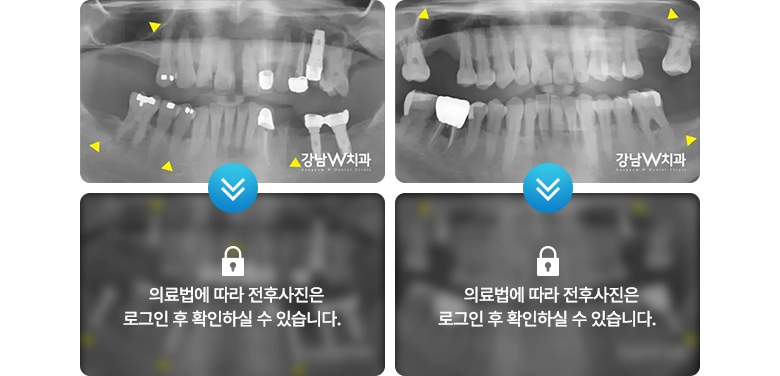의료법에 따라 전후사진은 로그인 후 확인하실 수 있습니다.