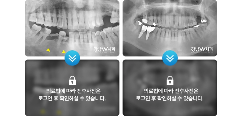 의료법에 따라 전후사진은 로그인 후 확인하실 수 있습니다.
