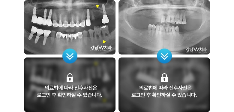 의료법에 따라 전후사진은 로그인 후 확인하실 수 있습니다.