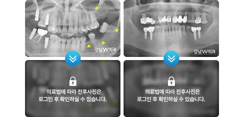 의료법에 따라 전후사진은 로그인 후 확인하실 수 있습니다.