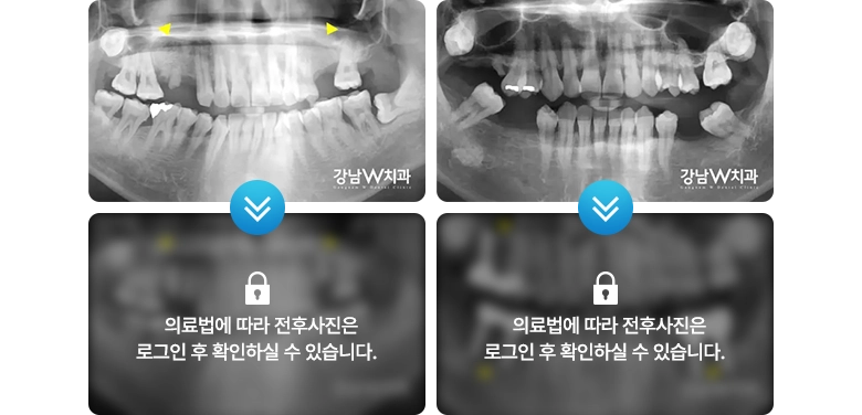 의료법에 따라 전후사진은 로그인 후 확인하실 수 있습니다.