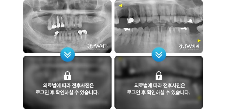 의료법에 따라 전후사진은 로그인 후 확인하실 수 있습니다.