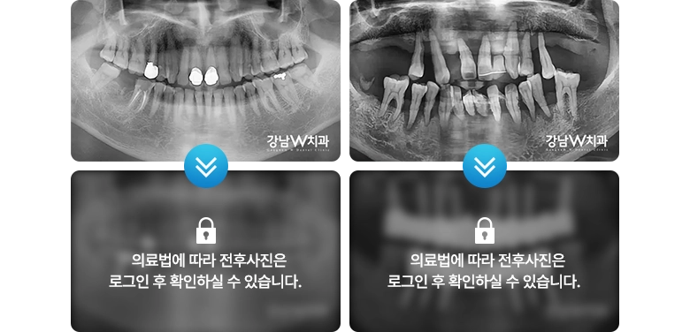 의료법에 따라 전후사진은 로그인 후 확인하실 수 있습니다.