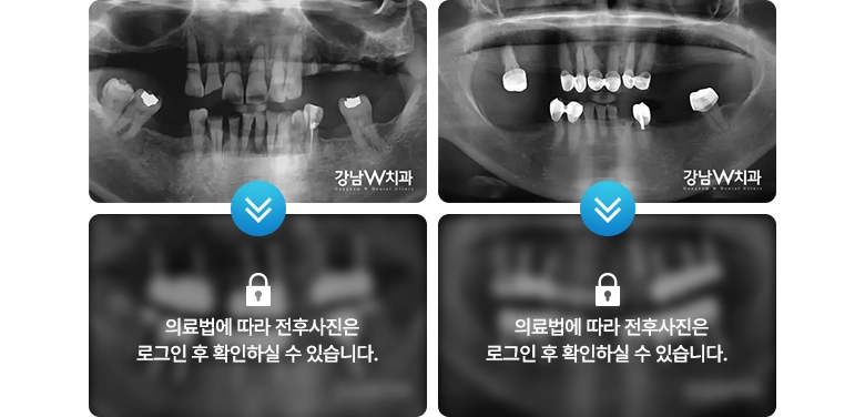 의료법에 따라 전후사진은 로그인 후 확인하실 수 있습니다.