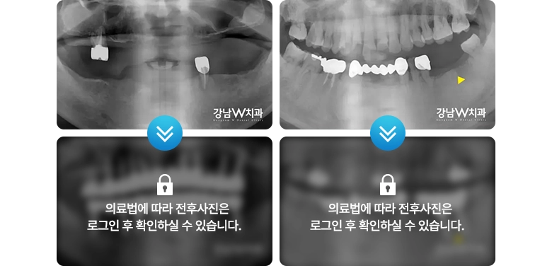 의료법에 따라 전후사진은 로그인 후 확인하실 수 있습니다.