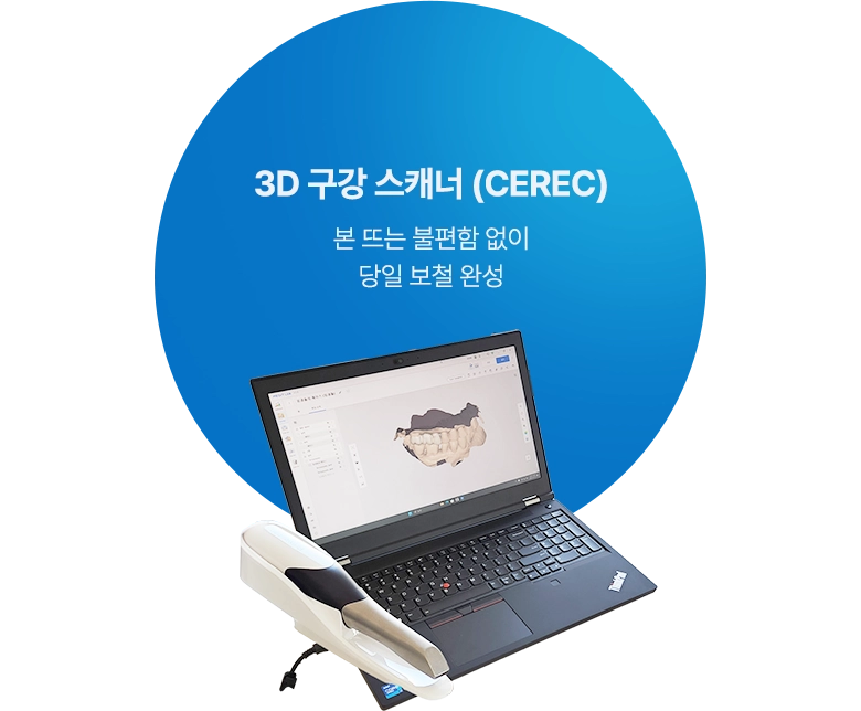 3D 구강 스캐너 (CEREC) / 본 뜨는 불편함 없이 당일 보철 완성