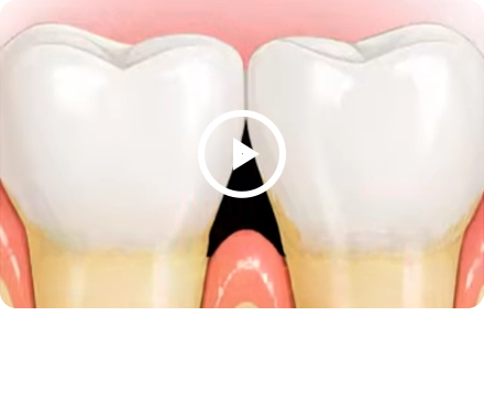 블랙트라이앵글은? 어떻게 치료할까?